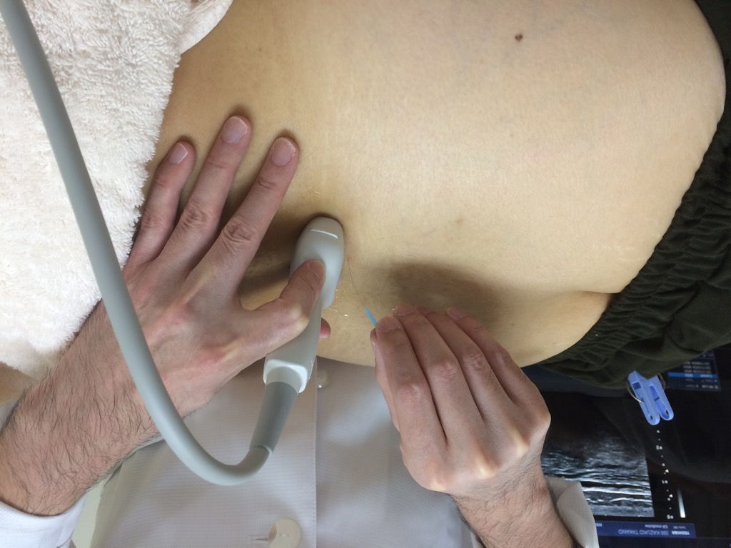 腰部に超音波エコープローブを当てている写真