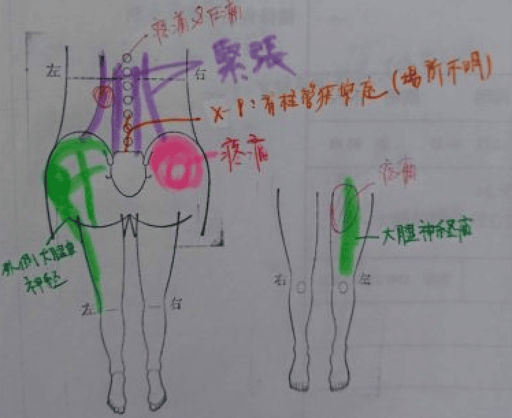 腰部脊柱管狭窄症の鍼灸症例報告 No.2045（60代男性）（症例報告サムネイル）