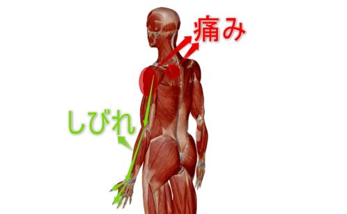 症例No.2017 来院時の痛み・しびれの部位（背面と上肢）