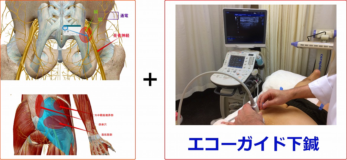 エコーガイド下陰部神経＆坐骨神経周囲ファシアリリース鍼通電療法の施術イメージ図