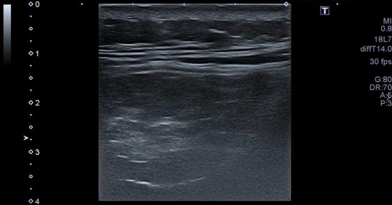 腰痛の多裂筋ファシアリリース鍼の施術イメージ