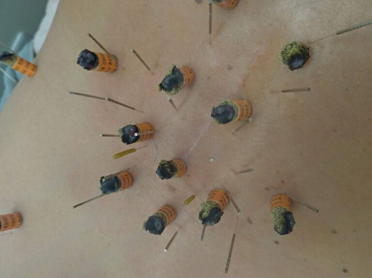 脊柱管狭窄症に対する鍼灸施術の様子（腰部への鍼と灸）