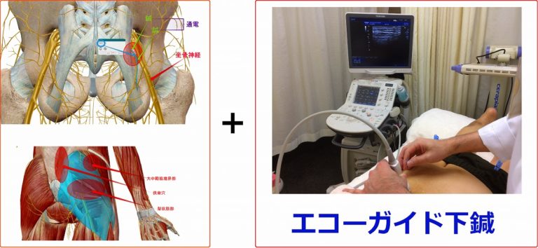エコーガイド下の鍼通電療法の施術イメージ（参考）