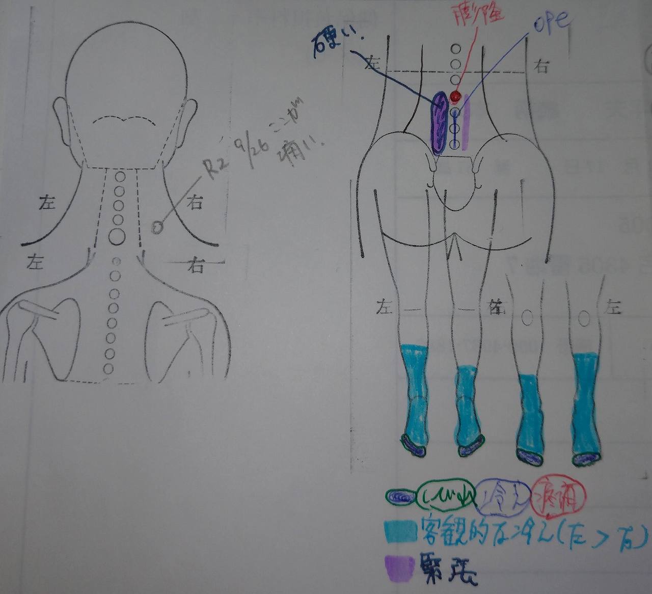 脊柱管狭窄症（手術後）の鍼灸症例報告No.2242(80代男性)