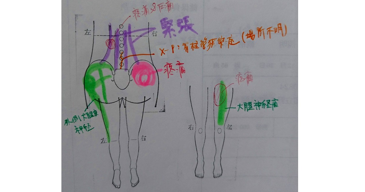 腰部脊柱管狭窄症の鍼灸症例報告No.2045（60代男性）