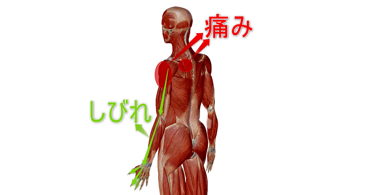 頚椎症(頸椎症)鍼灸症例報告No.2017(40代男性)