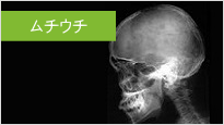 ムチ打ちの鍼灸（交通事故等の鍼灸）